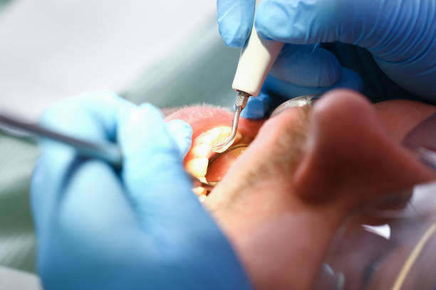 Best Emergency Treatment for Dental Infections or Abscesses in Mechanicsville, VA